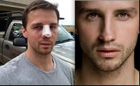 Simon Dexter Porn simon shocking before after pics gay porn star turned male escort dexters nose